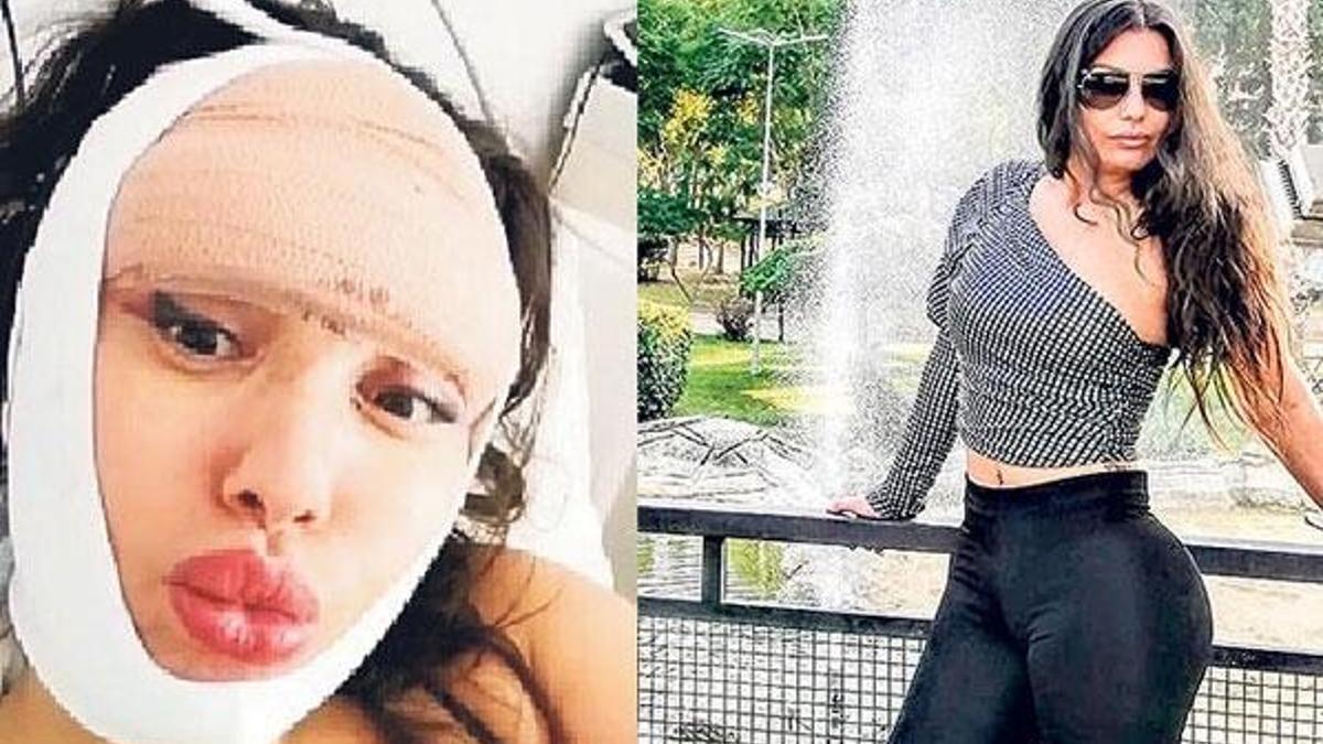 Estetik faciaları artıyor! Uzmanlar uyarıyor