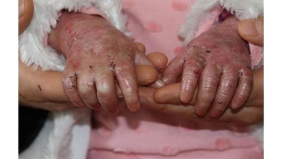 Tüm vücudu altüst eden hastalık: Lupus