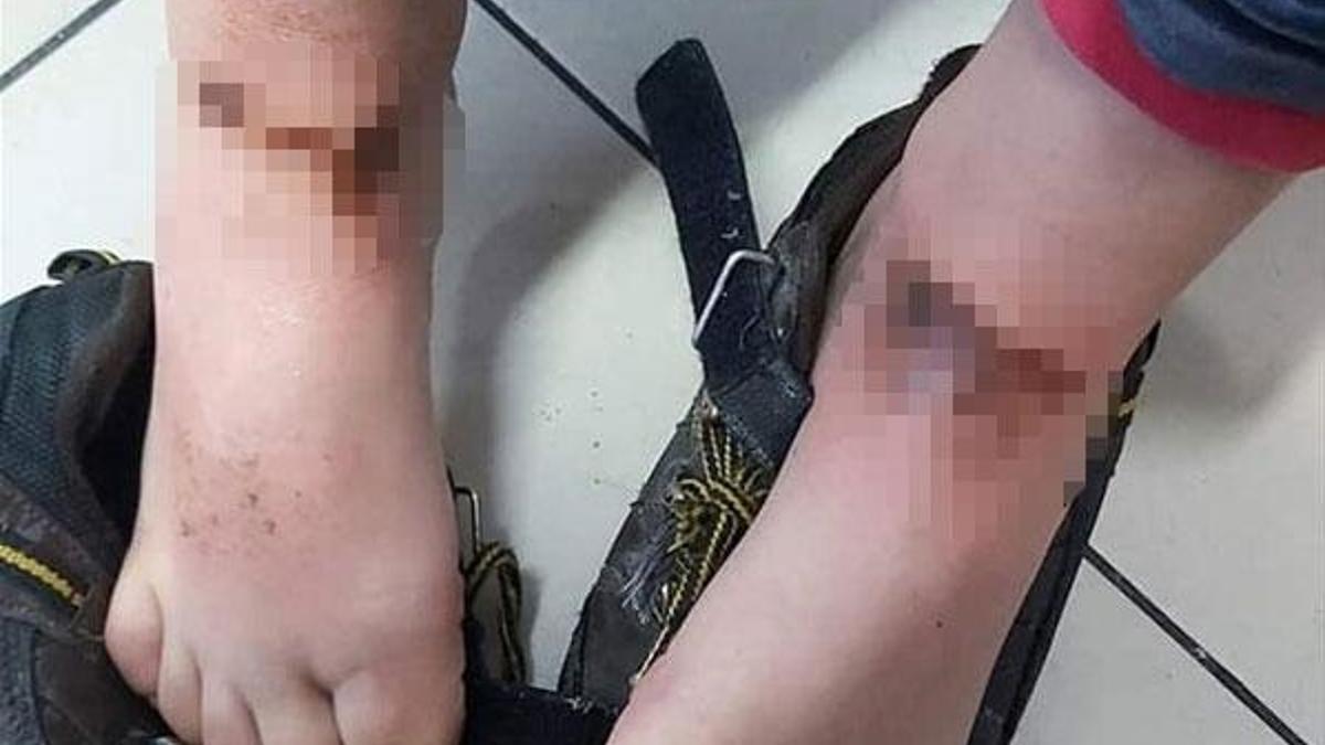 'Gizemli yanıklar' buz yaralanması çıktı