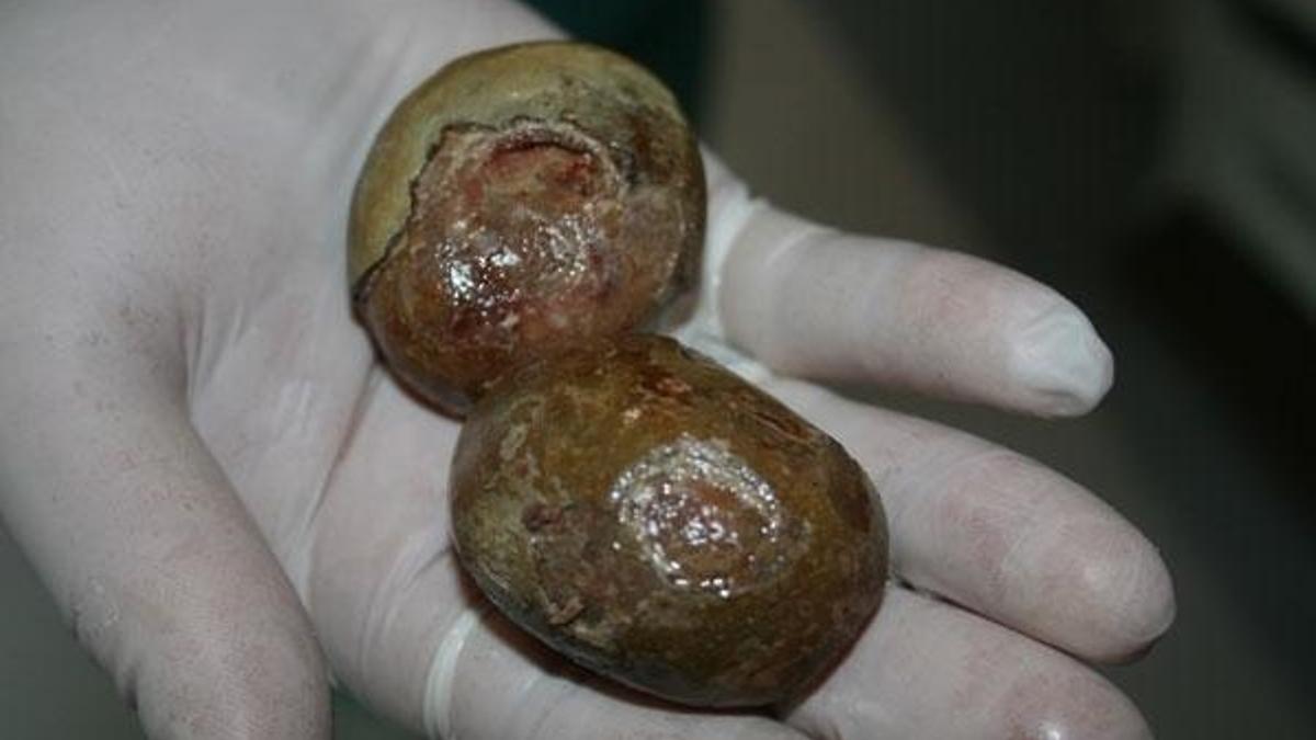 Mesanesinden 293 gram ağırlağında 2 taş çıkarıldı