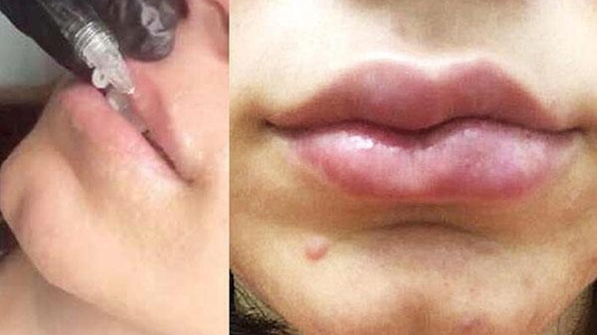 Doktorlar bile şoke oldu! Estetik uğruna dudağı yamuldu