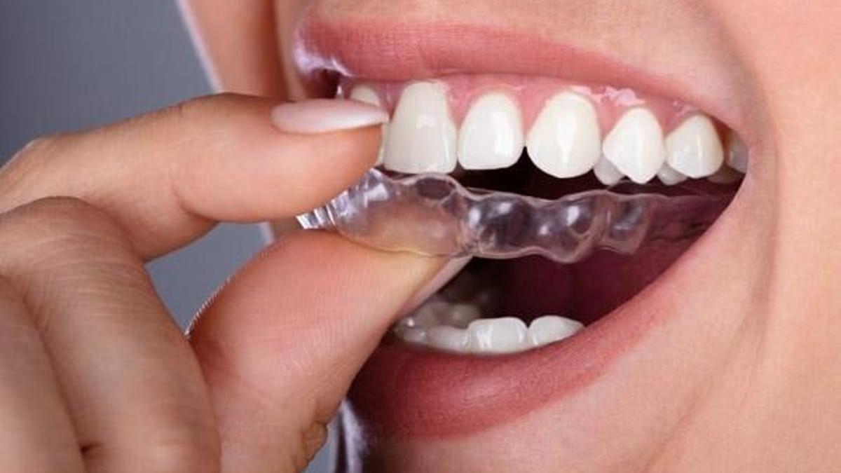 Ortodontik tedavi metodu invisalign