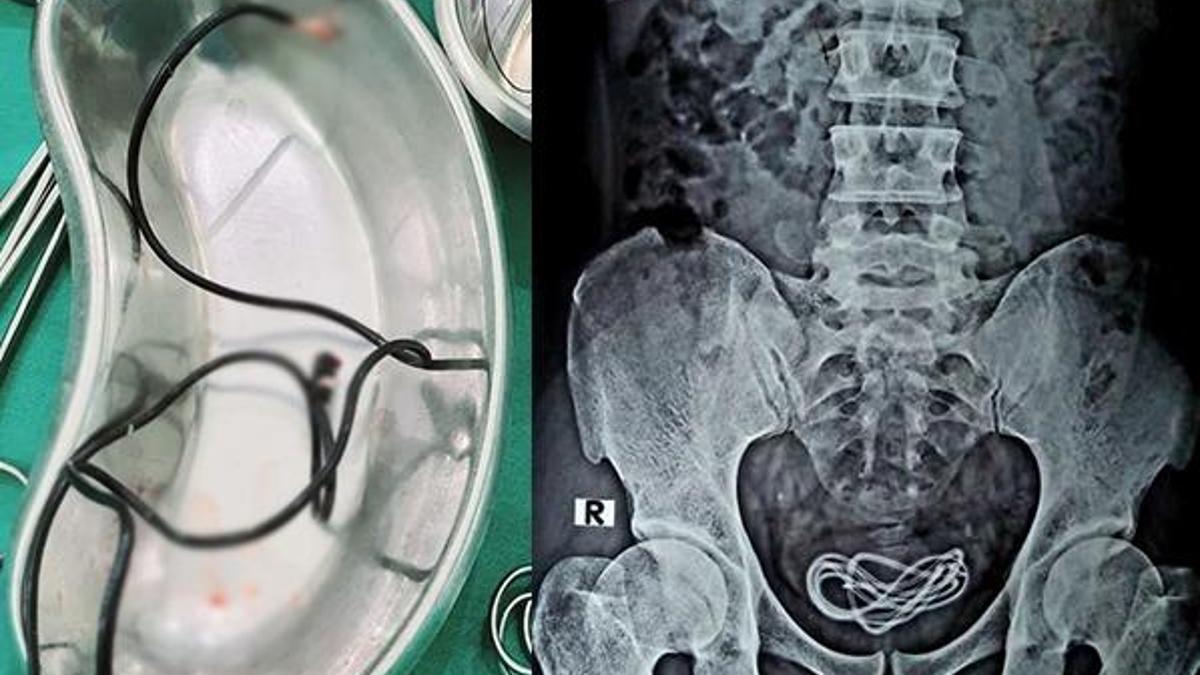 Tıp dünyası şaşkın! Mesanesinden bir metre uzunluğunda şarj kablosu çıktı