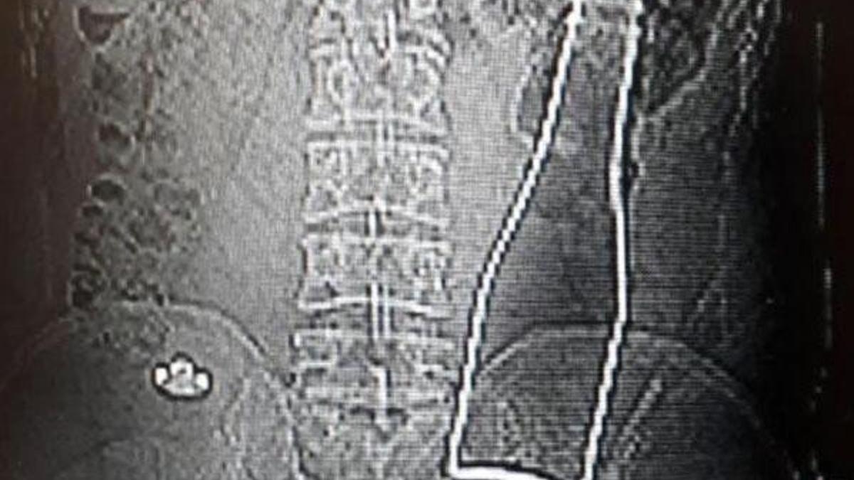 Doktorlar şaşkına döndü! Bağırsağından soda şişesi çıktı