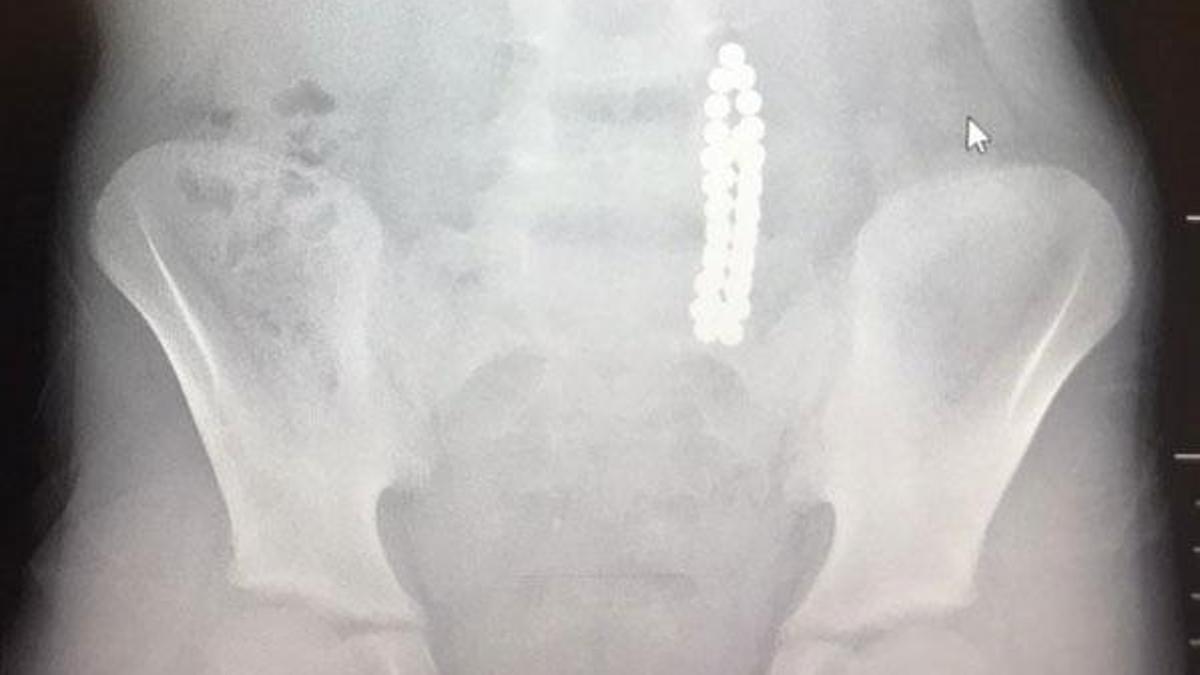 Doktorlar bile şaşırdı! 42 tane mıknatıs yuttu
