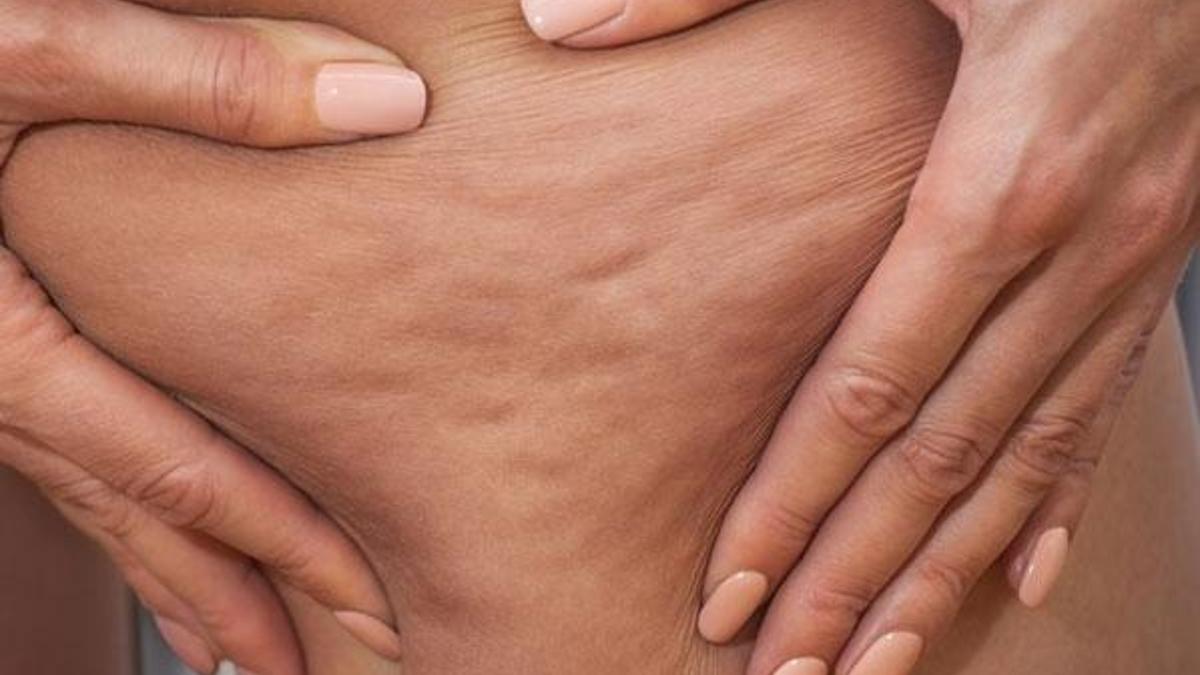 Kadınlarda sık görülen ağrılı selülite dikkat