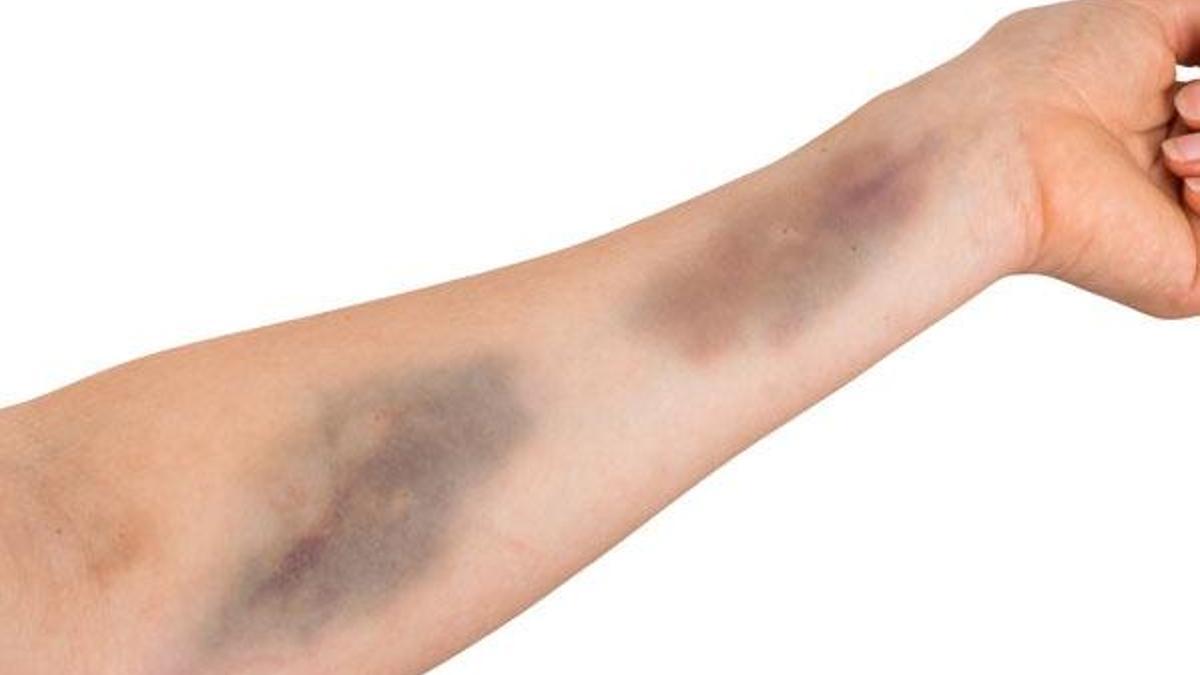 Ekimoz nedir? Ekimoz hematom farkı nedir?