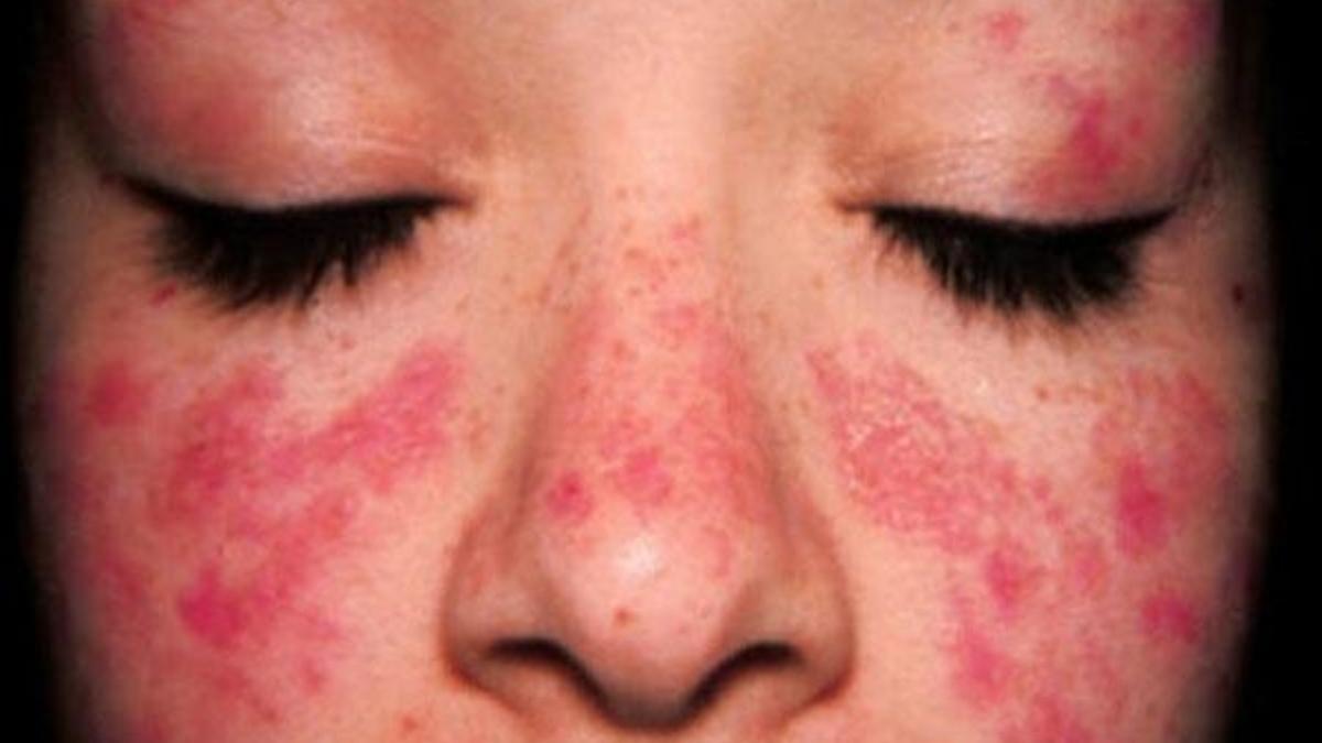 Kelebek Hastalığı nedir nasıl oluşur? Kelebek hastalığı (Lupus) bulaşıcı mı? Kelebek hastalığı belirtileri