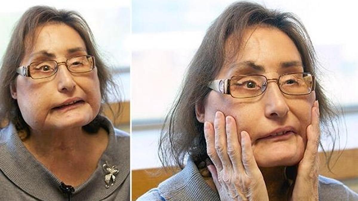 ABD’de ilk yüz nakli yapılan Connie Culp hayatını kaybetti
