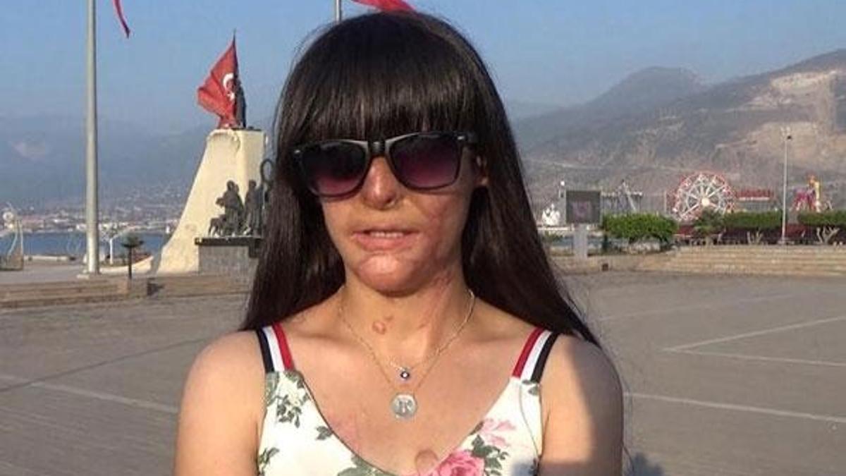 Yüzüne asit atan saldırganı affeden Berfin: Pişmanlık duydum