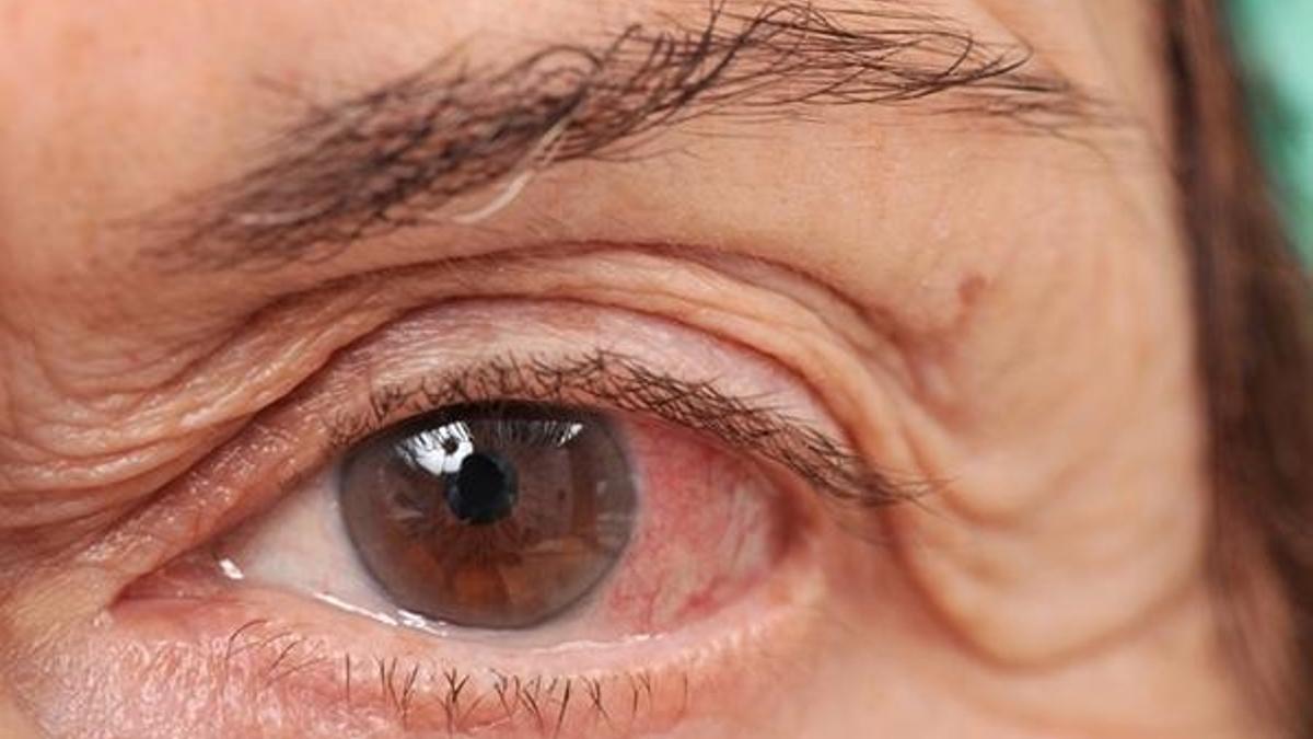 Genetik faktörler göz tansiyonu riskini 7 kat artırabiliyor