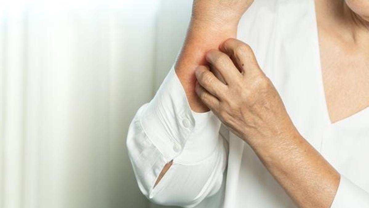 Bahar aylarındaki kaşıntının sebebi kurdeşen olabilir