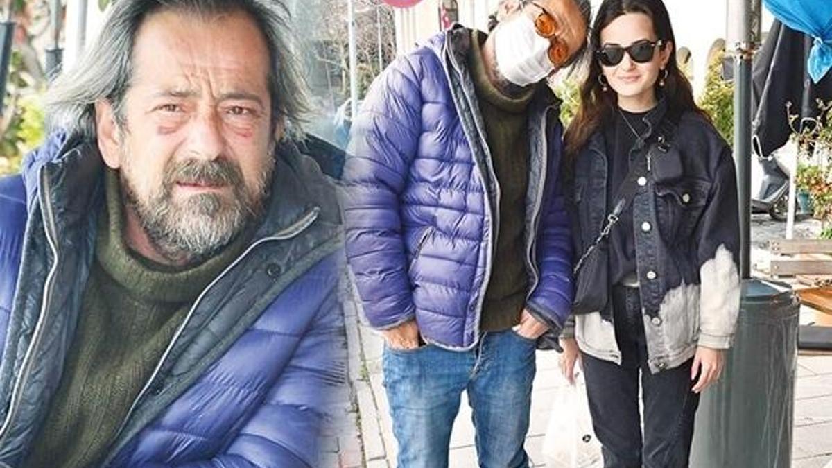 Feridun Düzağaç'ın göz altındaki morluk dikkat çekti: Dayak yedim
