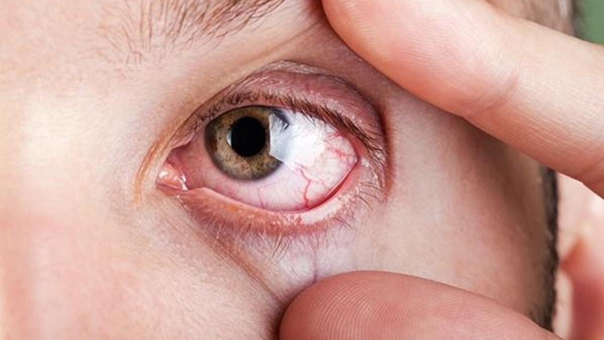 Sarı nokta hastalığı olanlara akıllı mercek takılmamalı