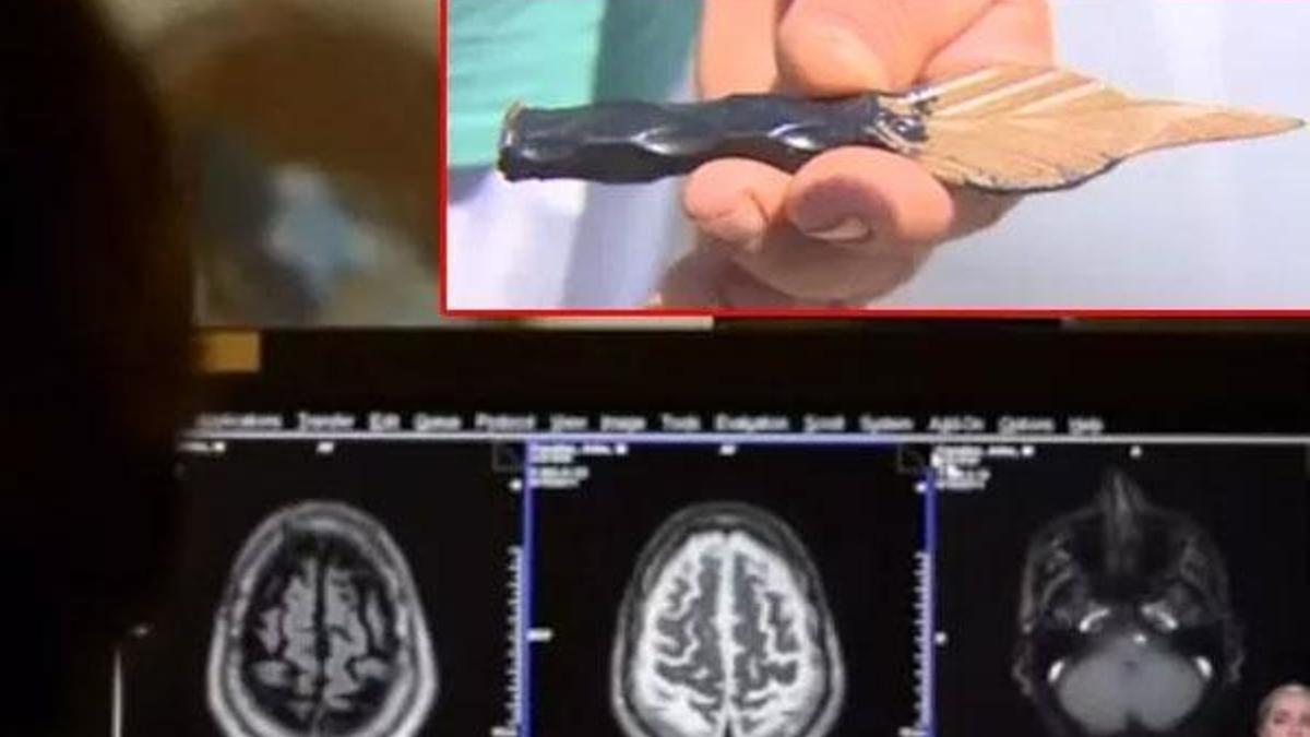 Akılalmaz olay! Doktor fark etmedi, 1 gün boyunca böyle gezdi