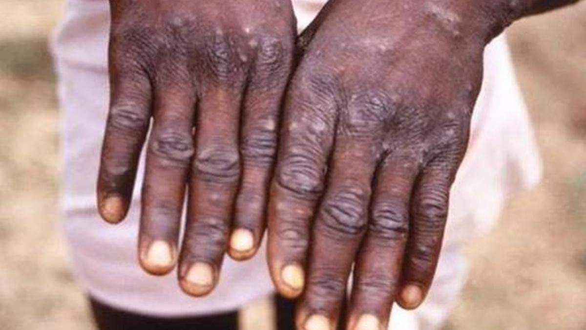 Maymun Çiçeği virüsü nedir? Maymun Çiçeği (Monkeypox) virüsü bulaşıcı mı, belirtileri nelerdir, salgına dönüşür mü?