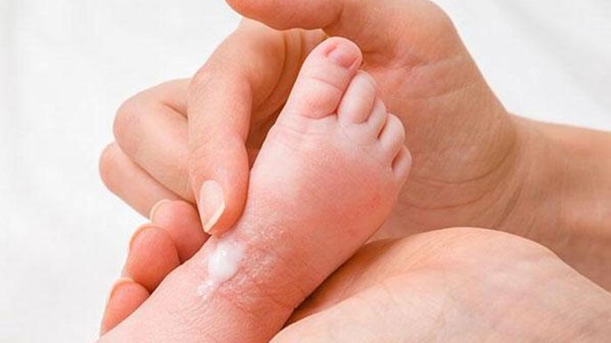 Bebeklerde görülen atopik dermatitin 8 belirtisi