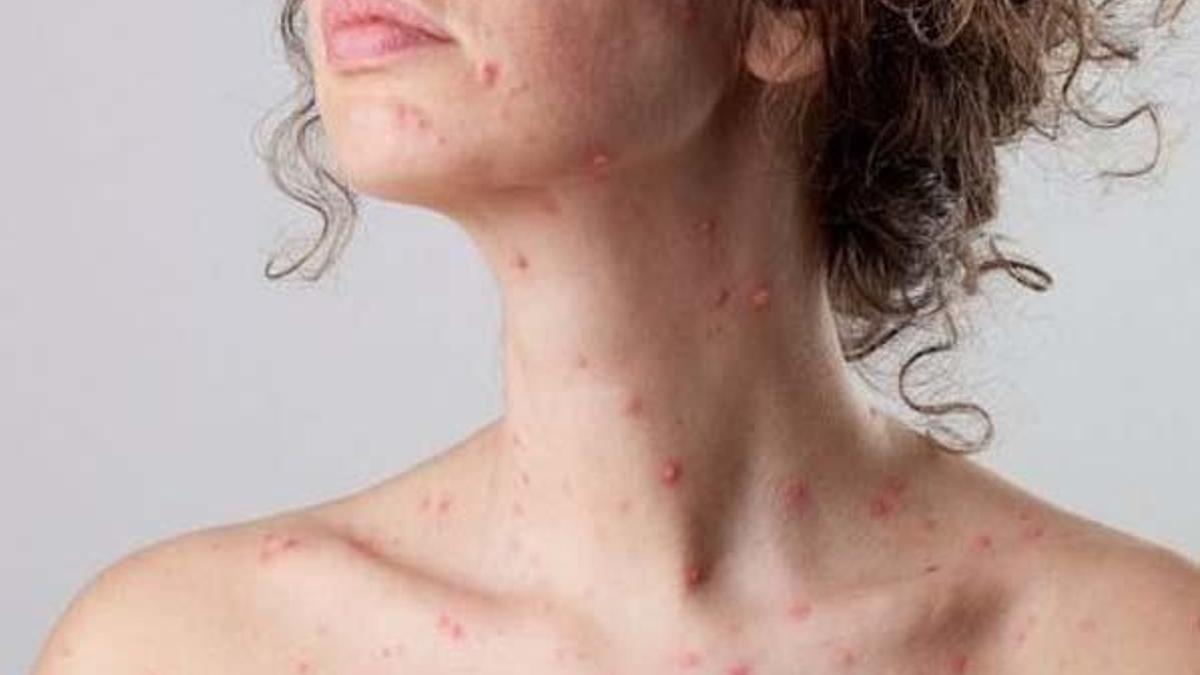 Çiçek hastalığı hala var mı, su çiçeği aynı şey midir?