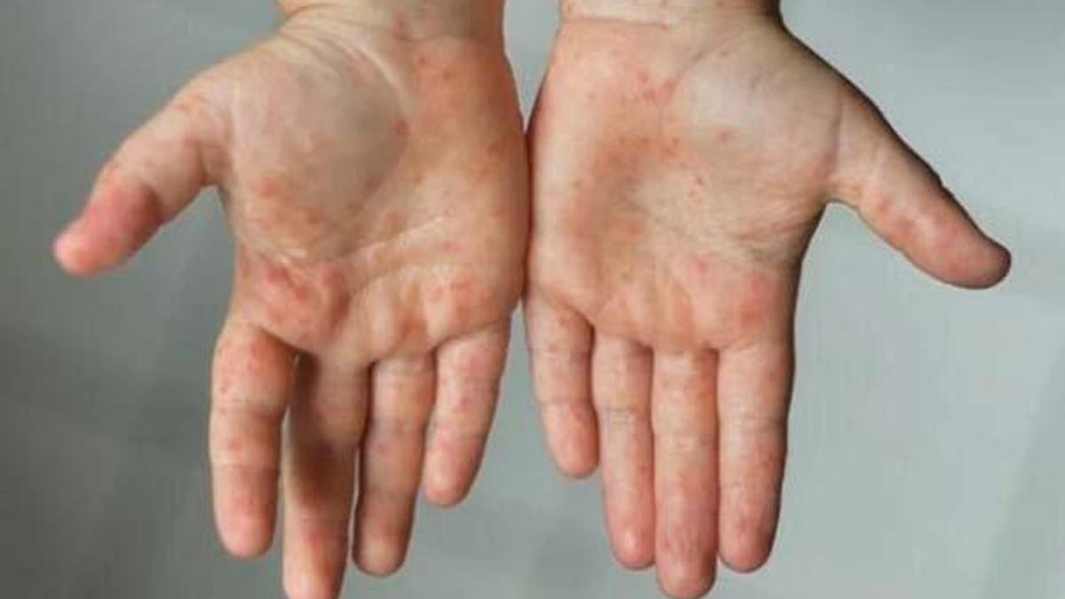 El ayak hastalığı neden olur, ne iyi gelir?