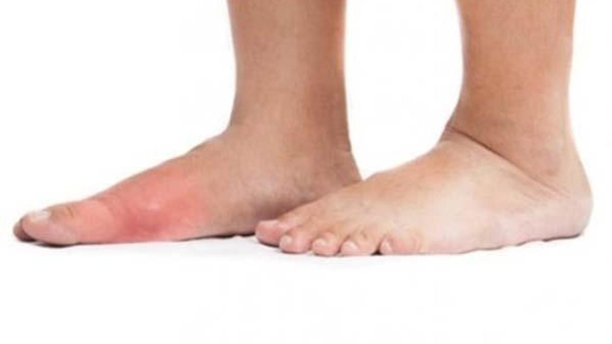 Gut hastalığına ne iyi gelir? Gut hastalığı olanlar ne yemeli?