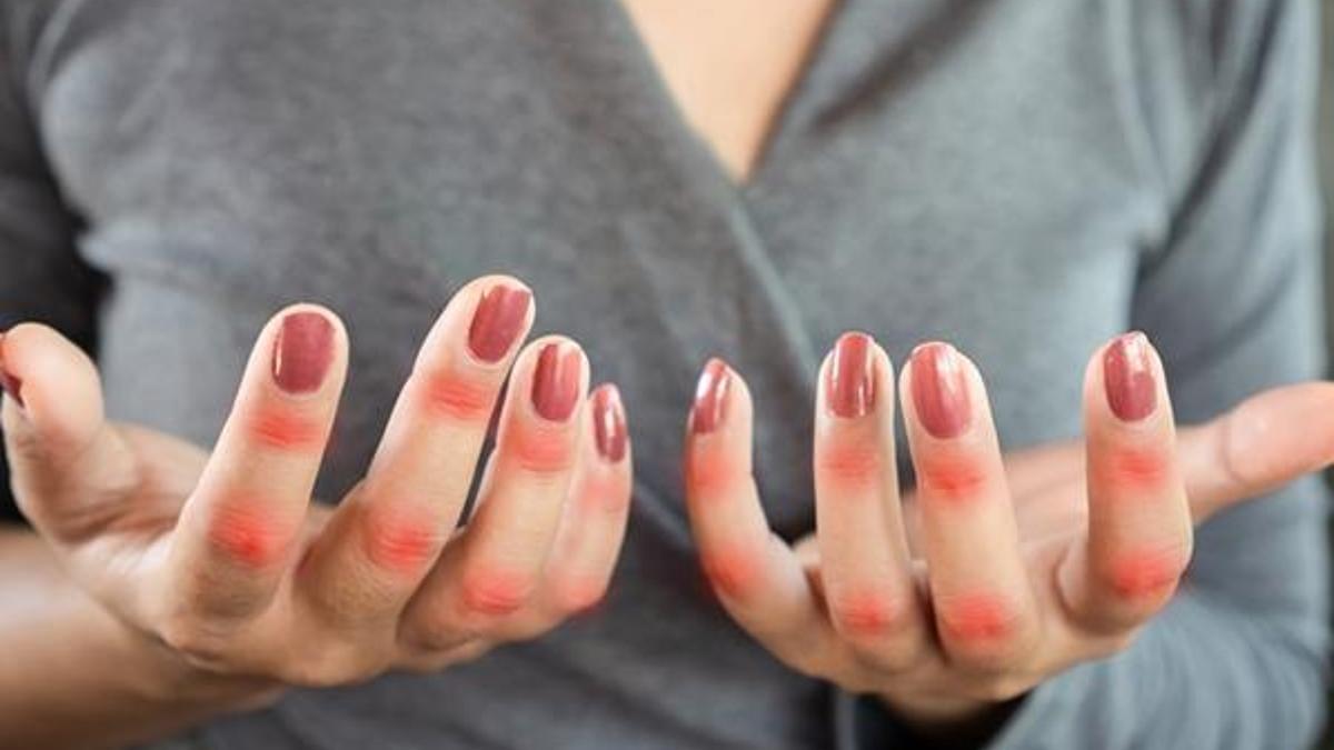 Kelebek hastalığı nedir? Lupus hastalığı belirtileri nelerdir?