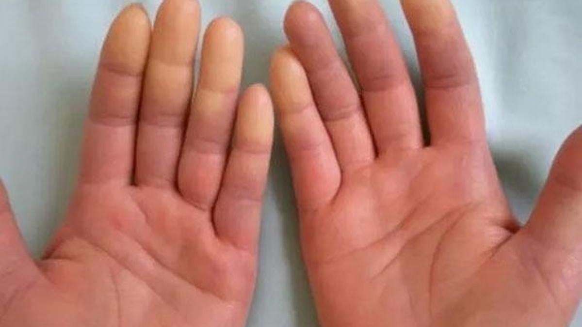 ‘Raynoud Sendromu’ enfeksiyona neden olabilir