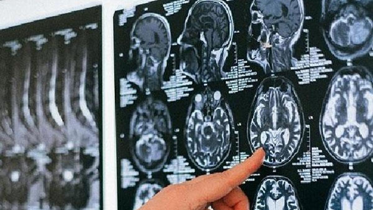 Serebral palsi; çocuklarda ilk 3 yaşa dikkat