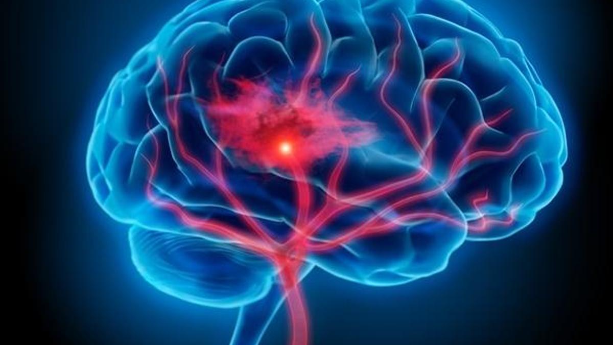 Dünya genelinde her 1 dakikada 1 kişi inme geçiriyor