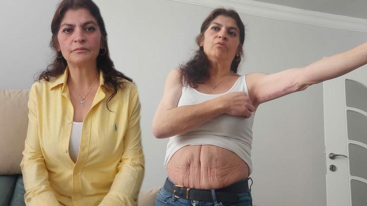 3 ameliyat geçirdi, estetik operasyonlar sonrası hayatı kabusa döndü!