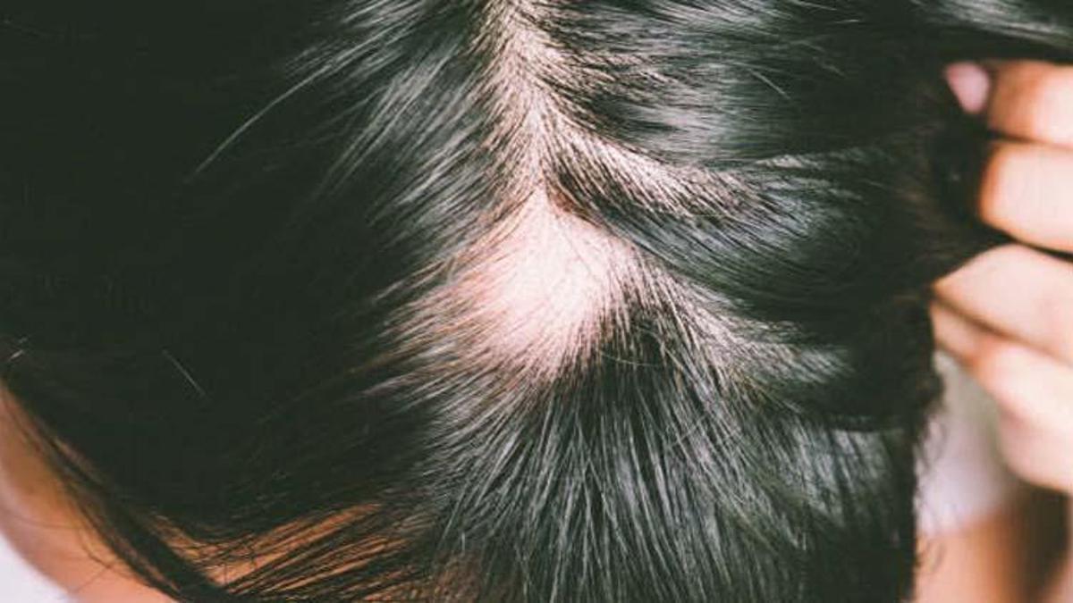 Alopesi nedir? Will Smith’in karısı Jada Pinkett Smith hastalığı Alopecia neden olur, Alopecia Areata nasıl anlaşılır, tedavisi var mı?