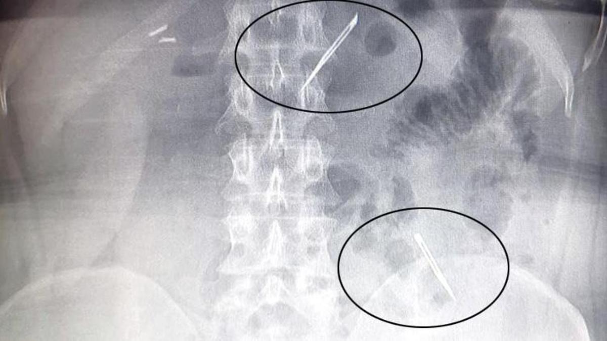 Mide ağrısıyla hastaneye gitti, röntgende gördüklerine inanamadılar! 'Yutmuş olabilirim'