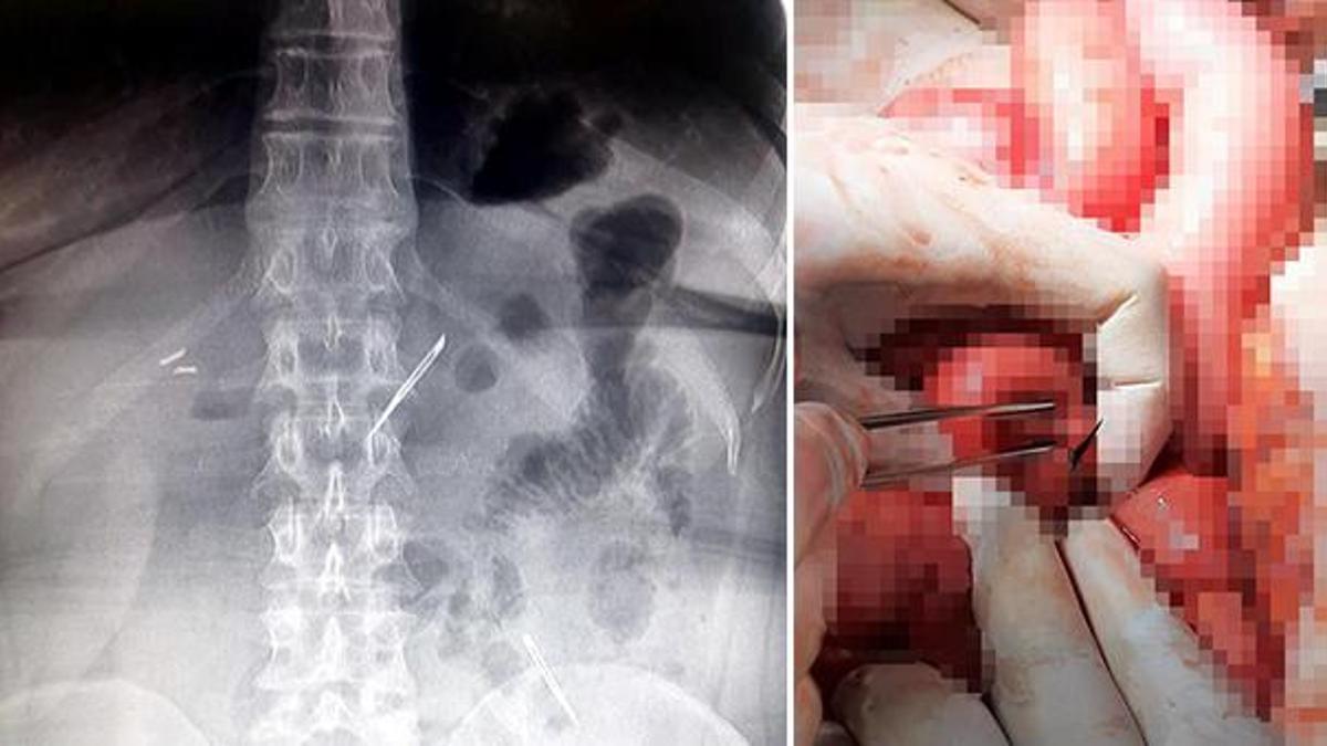Doktorlar bile inanamadı! Karın ağrısı şikayetiyle gitti hayatının şokunu yaşadı