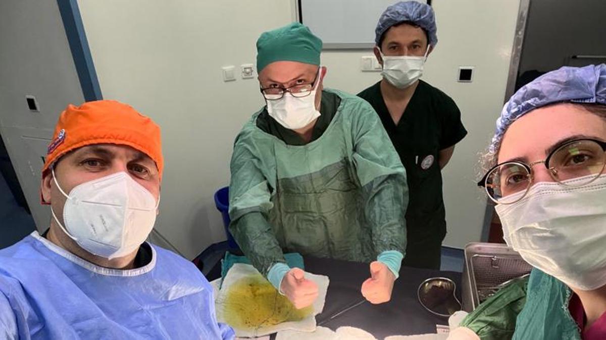 Safra kesesinden 1250 taş çıktı, doktor ismini yazdı