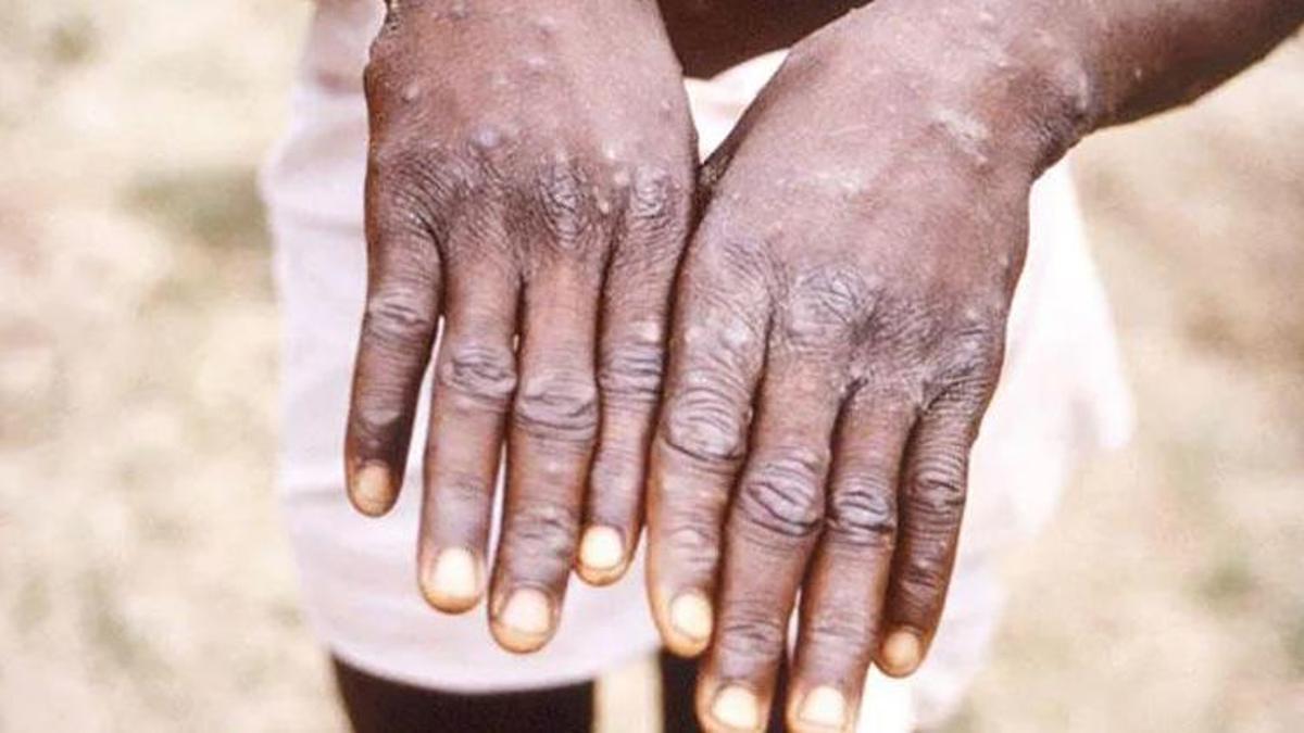 DSÖ'den maymun çiçeği mesajı: Toplu aşılamaya gerek yok