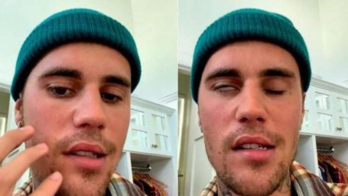 Justin Bieber'ın hastalığı ne? Ramsay Hunt sendromu nedir, belirtileri ne?