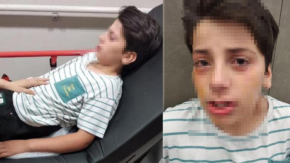 'Ses bombası yapımı' videosu izleyip evde denedi, karışım patladı! Çocuk gözlerinden yaralandı