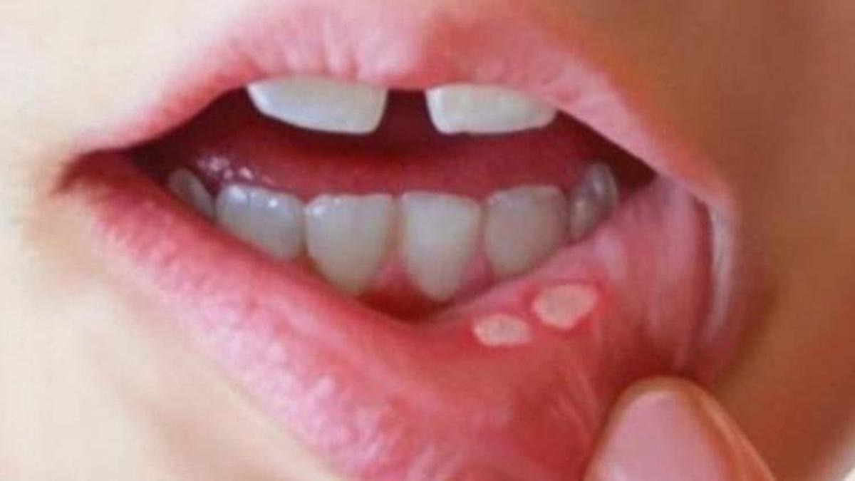 Ağız yarası korona belirtisi mi, korona belirtileri arasında ağız yarası var mı? Yeni belirtiler ortaya çıktı!