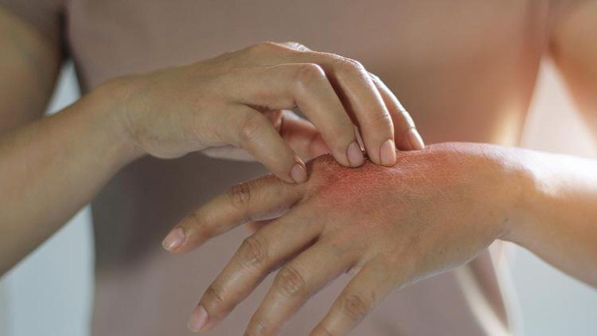 Alerjen madde ve stres egzamayı tetikliyor! Farklı belirtilerle ortaya çıkıyor