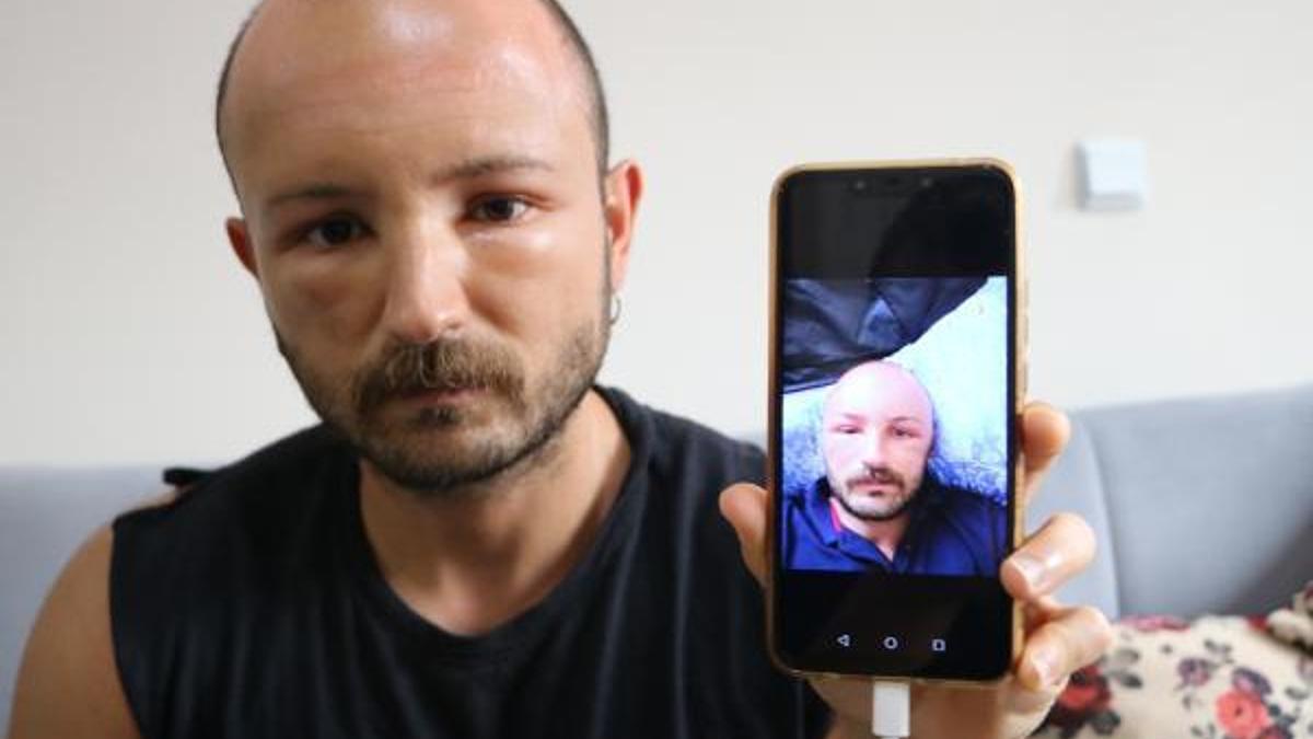 2 gün plaja gitti, başında nadir görülen sıcak ödemi oluştu