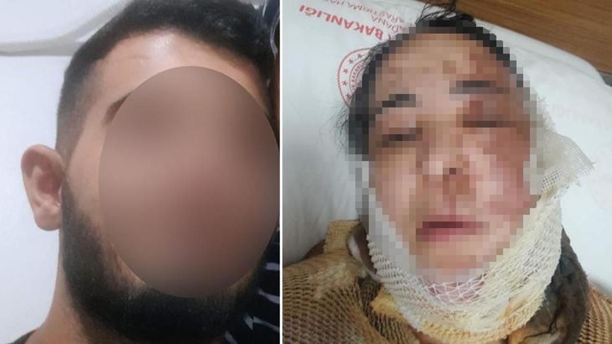 Üvey evlat dehşeti! Evlenmesin diye yüzüne kezzap döktü
