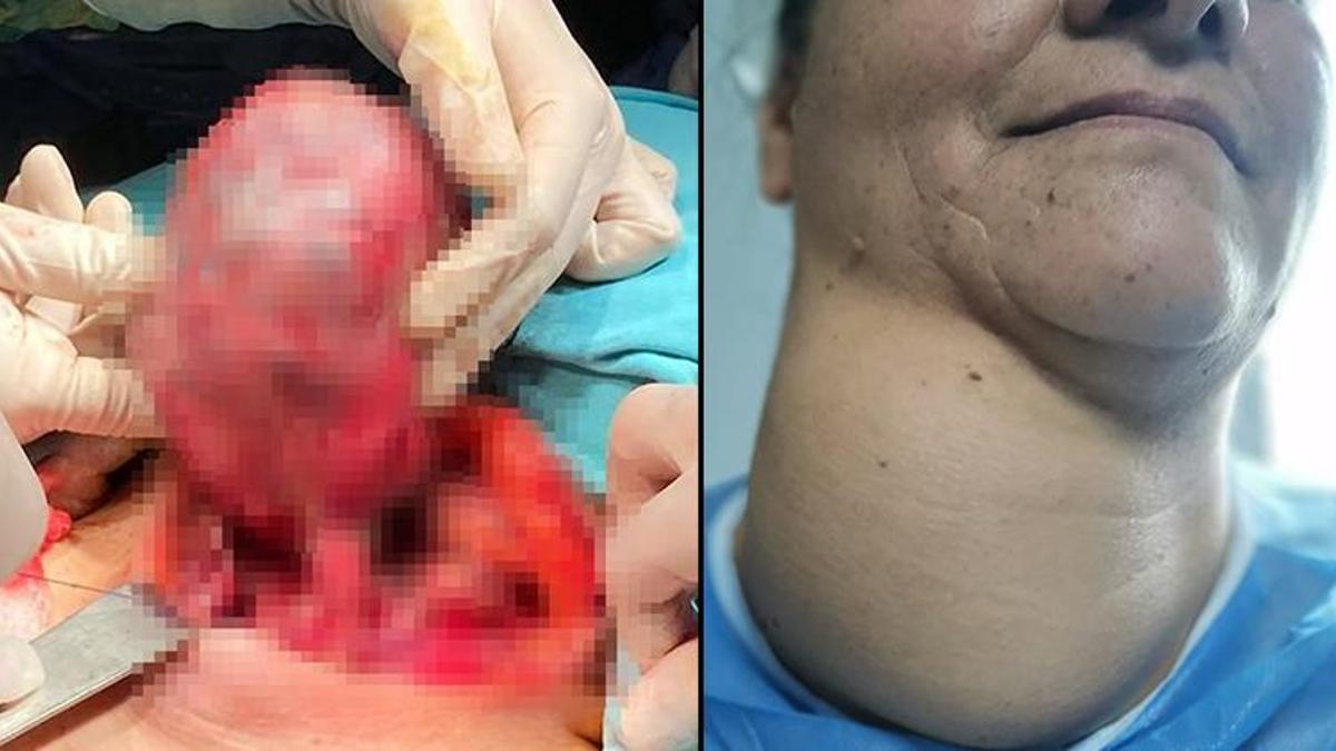 Nefes darlığı şikayetiyle gitti, boynundan 800 gram kitle çıktı