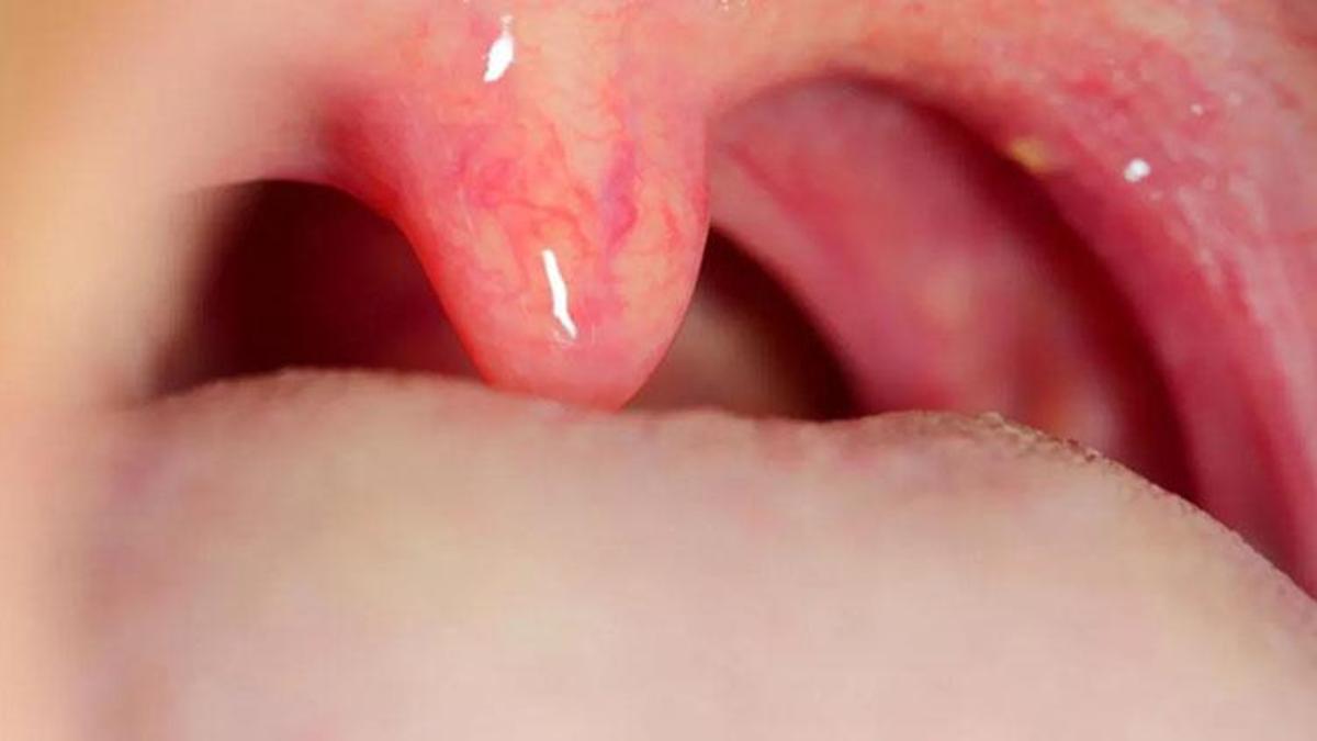 Streptokok nedir? Streptokok bakterisi belirtileri nelerdir, streptokok nasıl fark edilir?