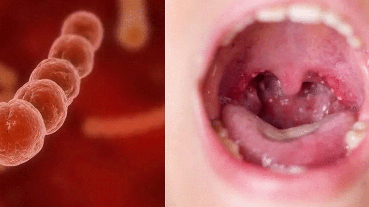 İşgalci şekle bürünen “Streptokok A” bakterisinde ölüm riski