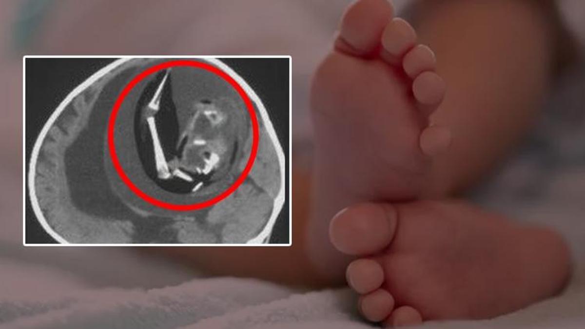 Beyninden ikiz kardeşini çıkardılar! Doktorlar şokta, 1 yaşında tarihe geçti