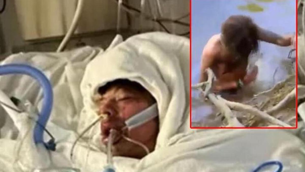 TikTok meydan okuması, vücudunun yüzde 80'ini yaktı!