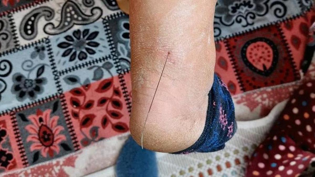 Ayak topuğundan 37 santim tel çıktı! Suç duyurusunda bulundu