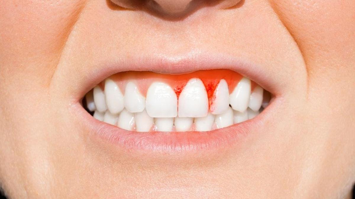Diş Eti İltihabı Nasıl Geçer? Diş Eti İltihabı Geçiren Yöntemler, Püf Noktaları Nelerdir?