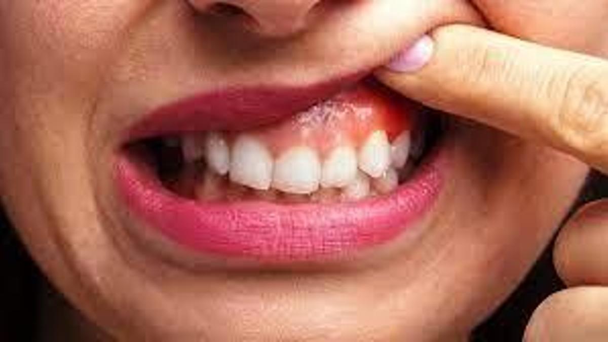 Diş Eti Şişmesi Nasıl Geçer? Diş Eti Şişmesi Geçiren Yöntemler, Püf Noktaları Nelerdir?