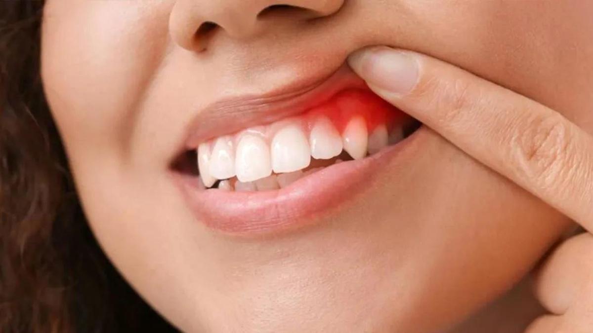 Diş İltihabı Nasıl Geçer? Diş İltihabı Geçiren Yöntemler, Püf Noktaları Nelerdir?