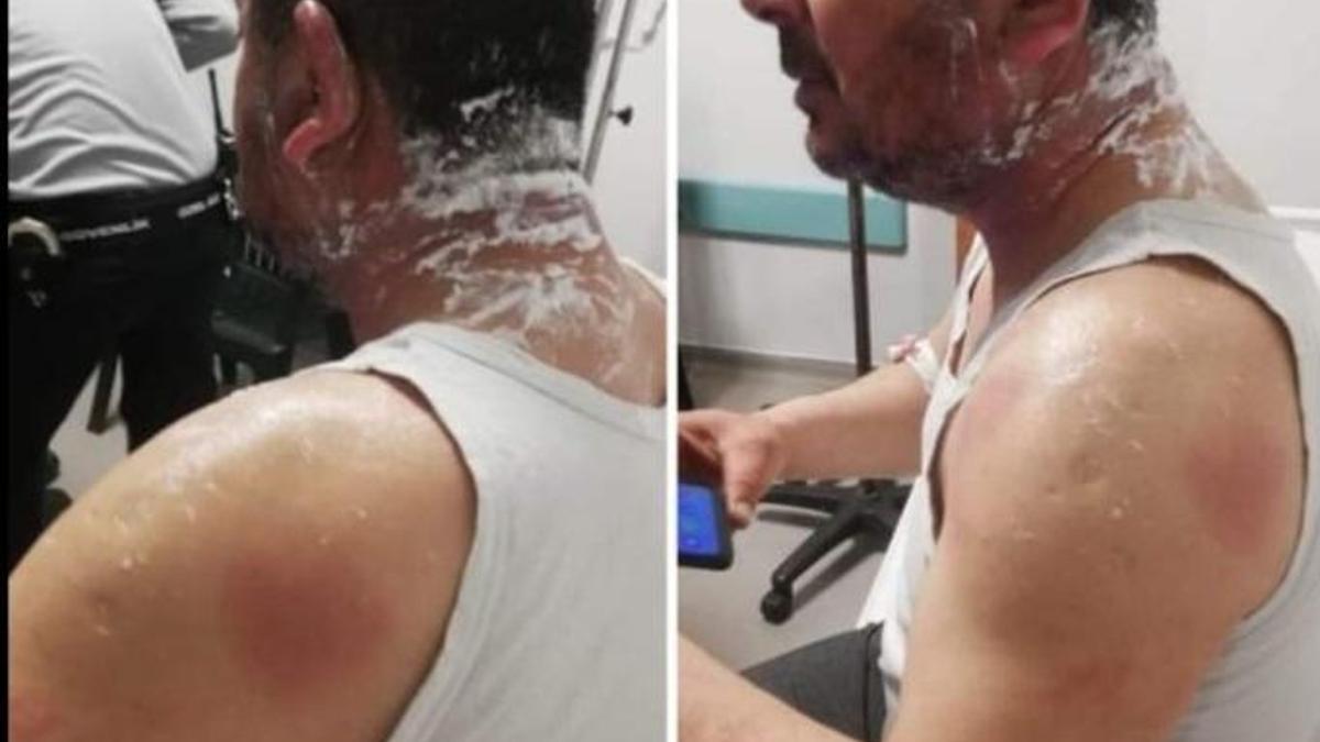 Hatay'da, tartıştığı kiracısına asitle saldırdı